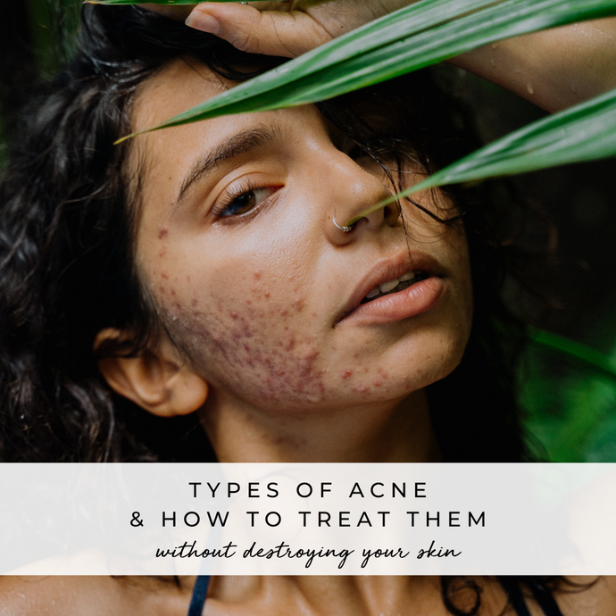 A Guide To The Different Types of Acne and How to Treat Them